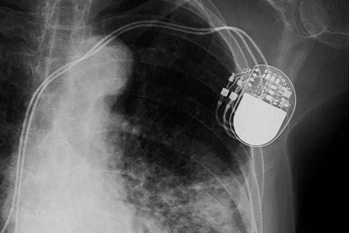 x-ray image of permanent pacemaker implant in body chest.