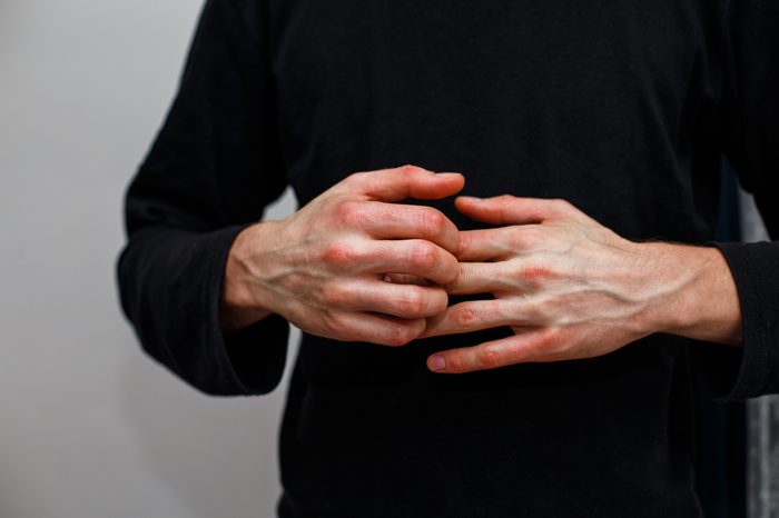 man scratching itchy hands, psoriasis