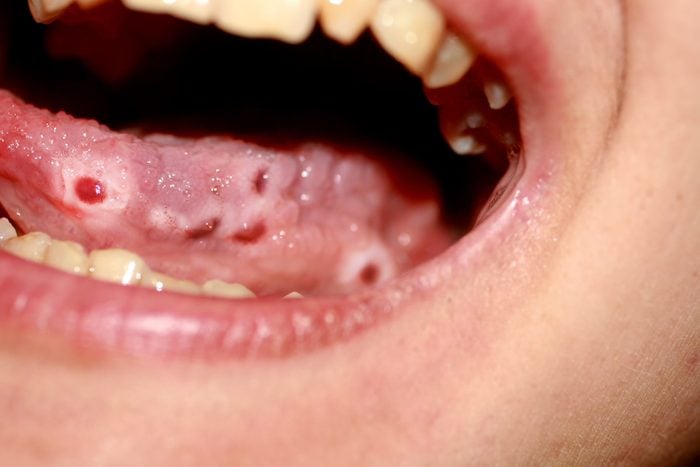 Amphotoid stomatitis. Candidiasis of the tongue. Ulcer on the tongue. Candida fungus.