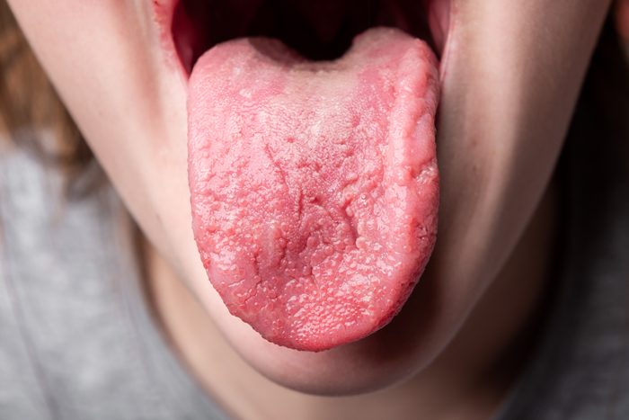 Cracks in the tongue. Candidiasis. Candida. Congenital pathology.