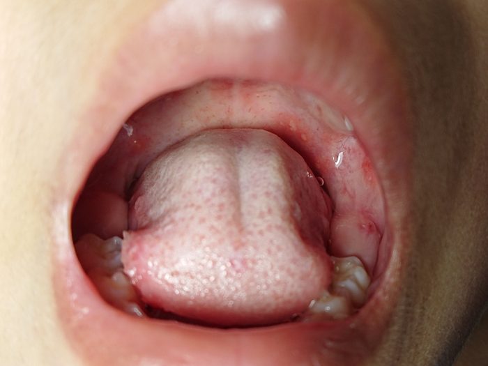 Herpangina or hand foot mouth disease oral lesions, painful ulcerative lesion on the pharynx in pediatric patient caused by acute viral infection. Focus at pharynx.