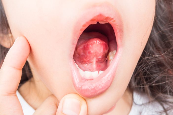 Red and white spot under tongue. Child infected with virus. Herpangina disease,Hand foot and mouth disease, HFMD