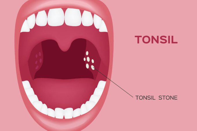 Tonsil Stones Signs Symptoms And Treatment The Healthy