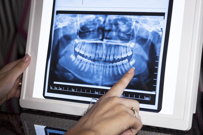 DEntal panoramic x-ray in viewer with finger pointing