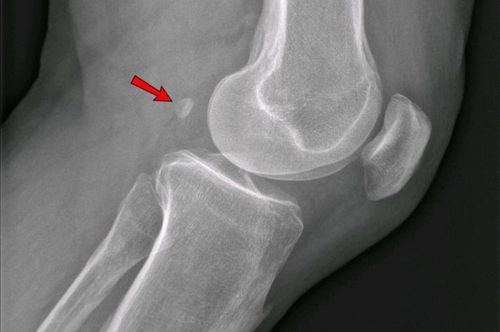 fabella knee bone