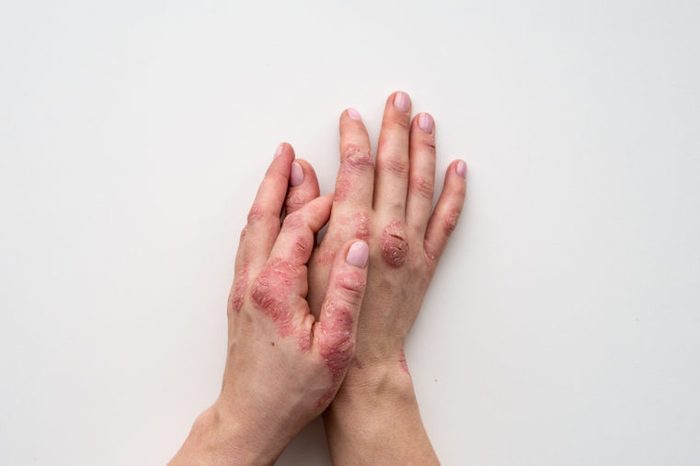 Psoriasis skin. Closeup of rash and scaling on the patient's skin. The concept of chronic disease treatment. Dermatological problems. Hard, horny and cracked skin in woman's hands. Dry skin. Isolated