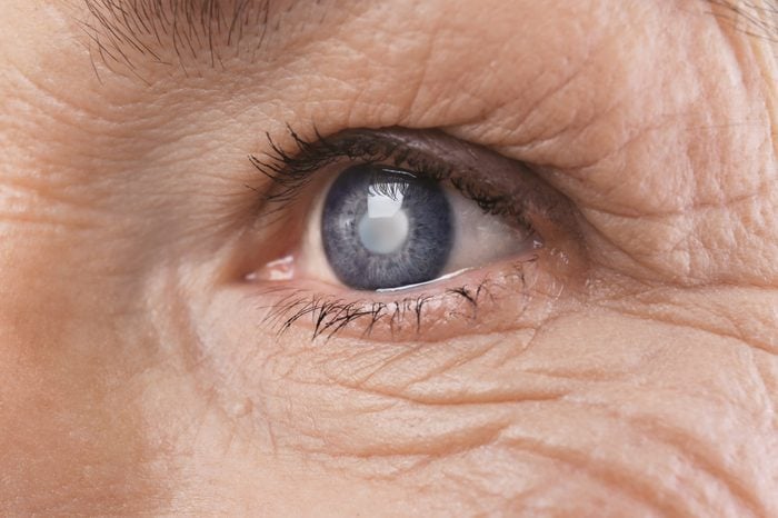 elderly glaucoma eyes Cataract senior