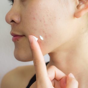 woman applying moisturizer to acne on face