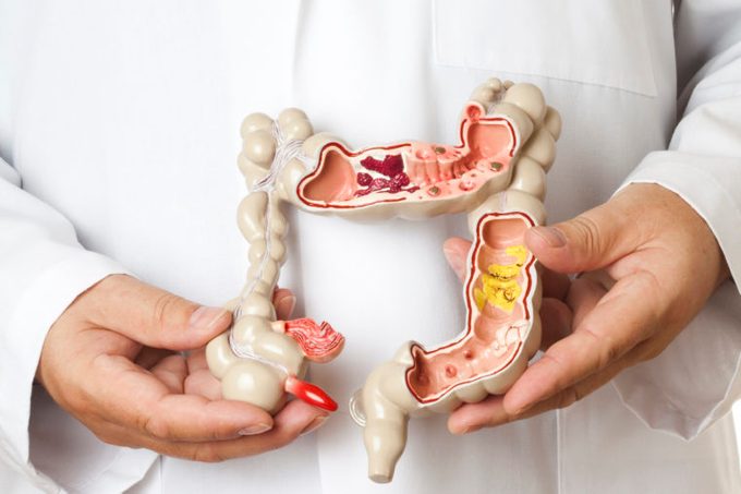 colorectal cancer signs medical model of a colon