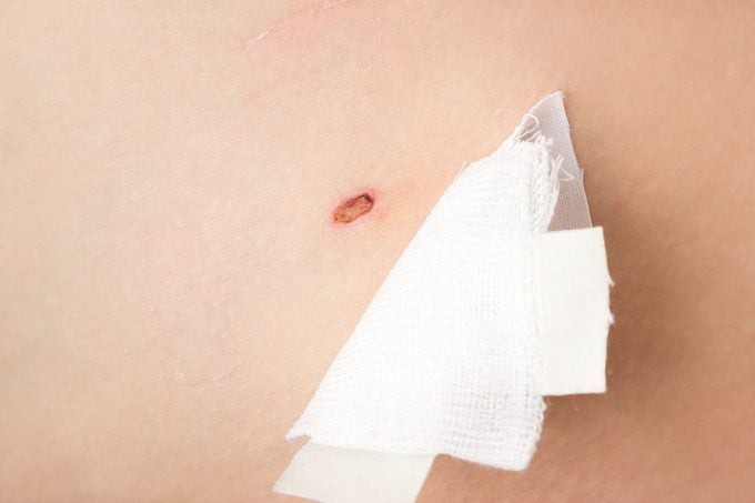 close up of wound after mole removal