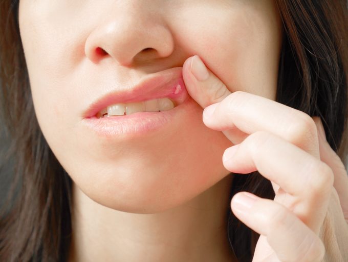 close up of woman showing canker sore inside mouth