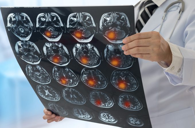 doctor holding scans of patient's brain