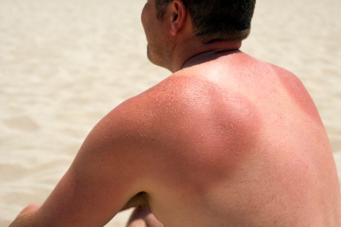 man sitting on beach with sunburn on his back