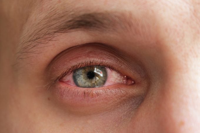 close up of man's eye with conjuntivitis