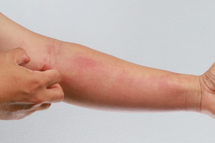 skin rash on arm