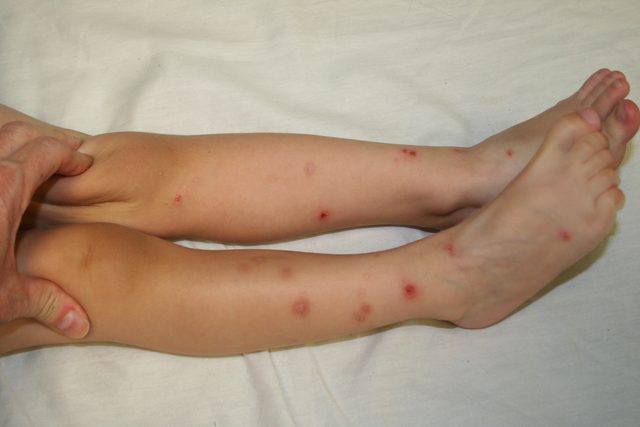 flea bites on small child's legs