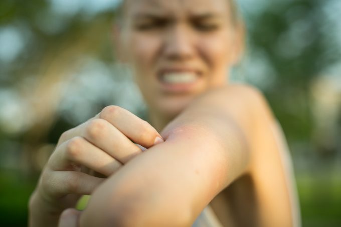 close up of woman with bug bite on arm
