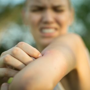 close up of woman with bug bite on arm