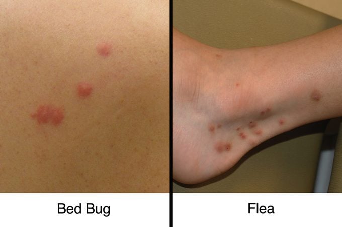 Bed Bug Bites vs. Fleabites: How to Tell the Difference | The Healthy