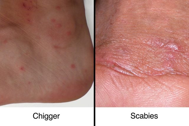 chigger vs scabies bites