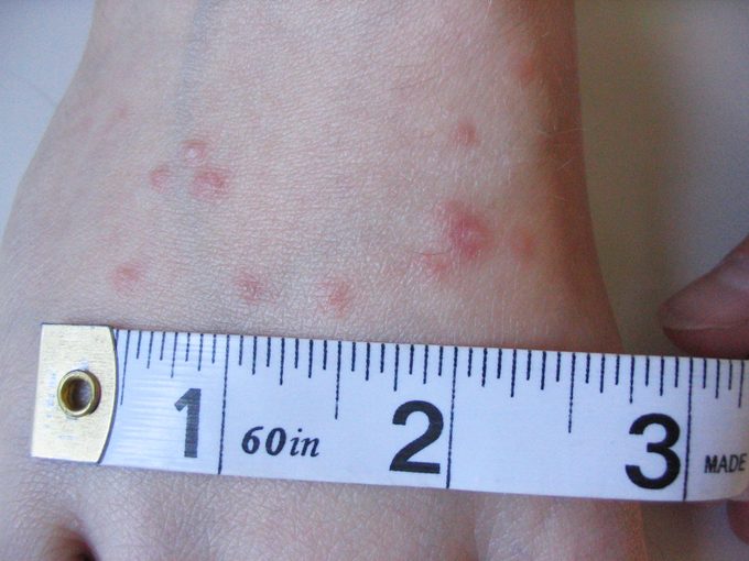 chigger bites with measuring tape