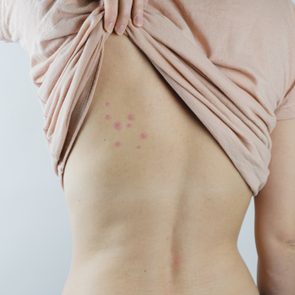 bug bites on woman's back