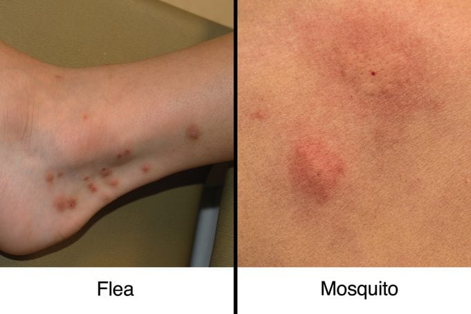 fleabite vs mosquito bite