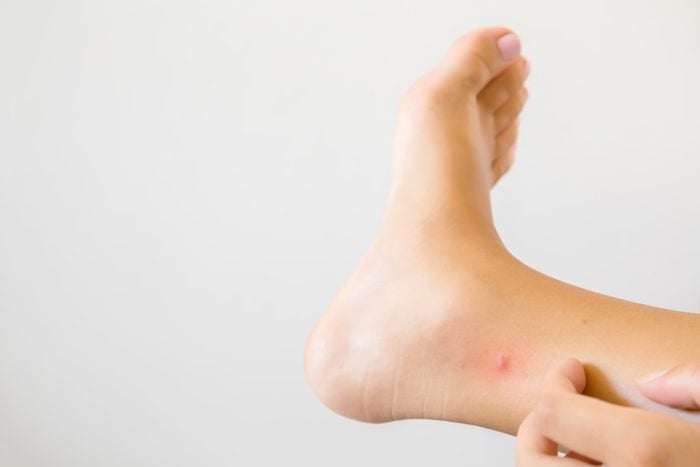 woman's hand itching bug bite on foot
