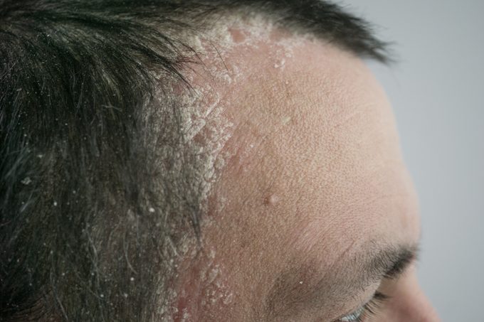 psoriasis on the hairline and on the scalp-close up, dermatological diseases, skin problems