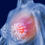 Breast Cancer: What Doctors Want You to Know About Symptoms, Treatment, and Prevention