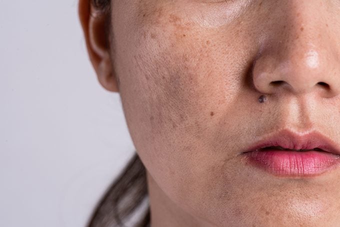Woman with problematic skin and acne scars. Problem skincare and health concept