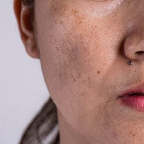 Woman with problematic skin and acne scars. Problem skincare and health concept