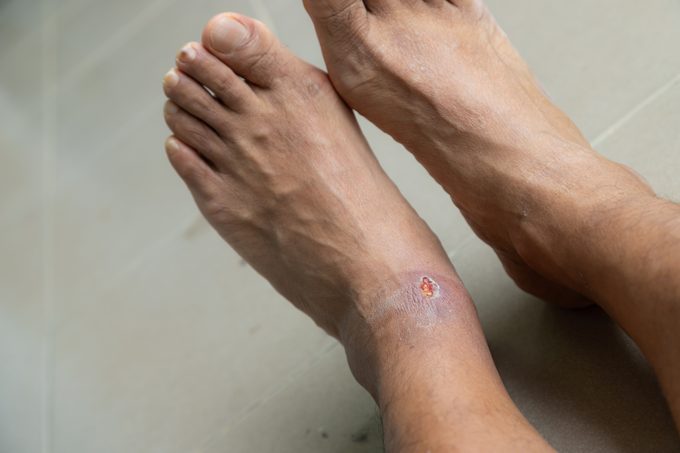 Foot ulcers caused by disease, health care concept.