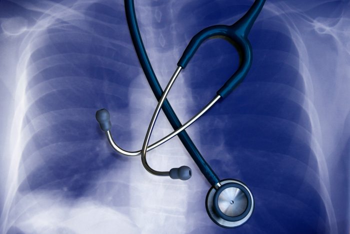 Stethoscope on Chest X-Ray