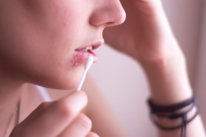 close up of woman putting q tip on cold sore