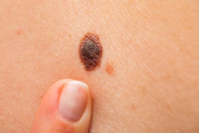 Dangerous nevus on skin - melanoma