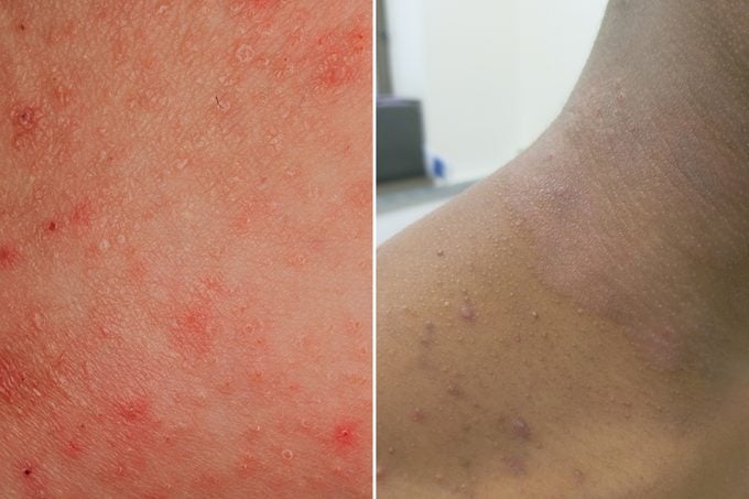eczema skin condition