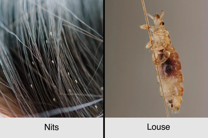 head lice nits vs louse