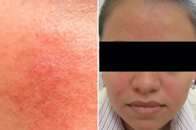 rosacea skin condition on face