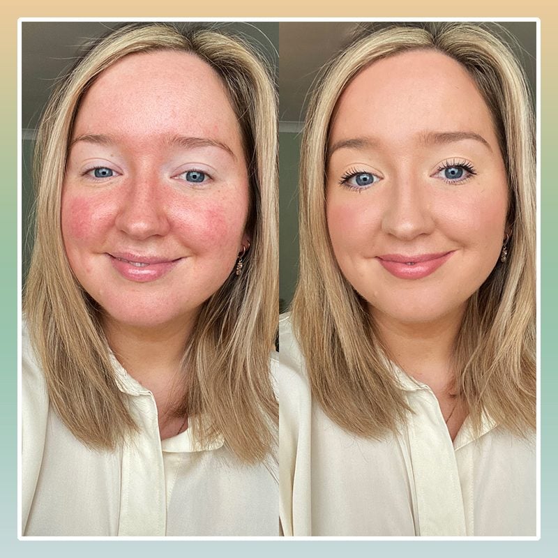 How A Beauty Pro Manages Her Rosacea Flare Ups The Healthy