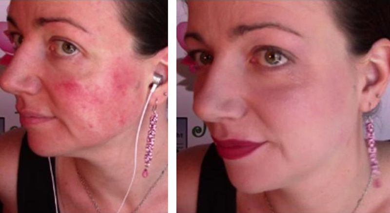 The Rosacea Treatments That Worked For Me The Healthy 