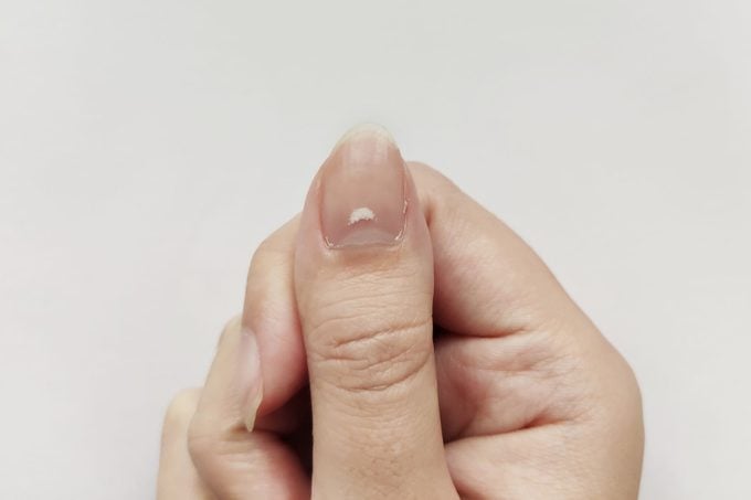 Witte vlekken op nagel geïsoleerd op een witte achtergrond.  Ziekte leuconychia