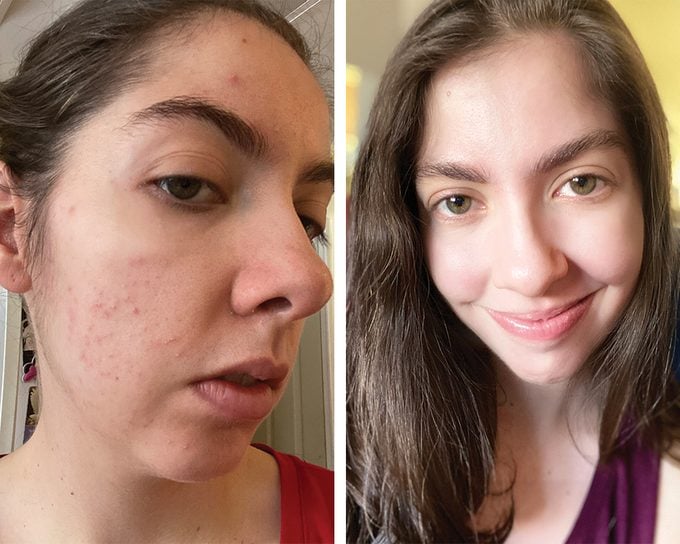 Emily Aaccutane Before And After01