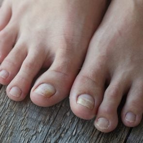 6 Causes of a Black Toenail and Treatments That Help | The Healthy