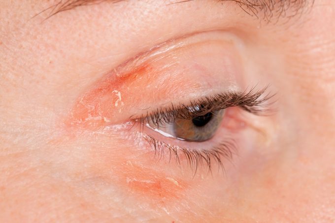 Psoriasis on a female eye