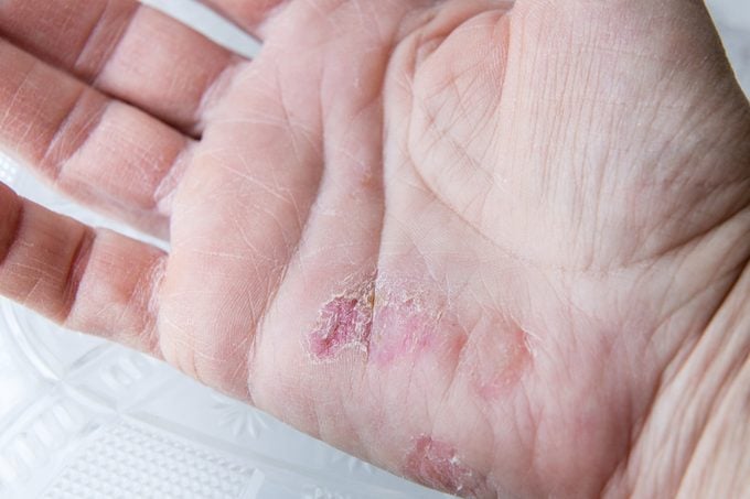 extreme sore dry cracked and peeling skin in the hand.