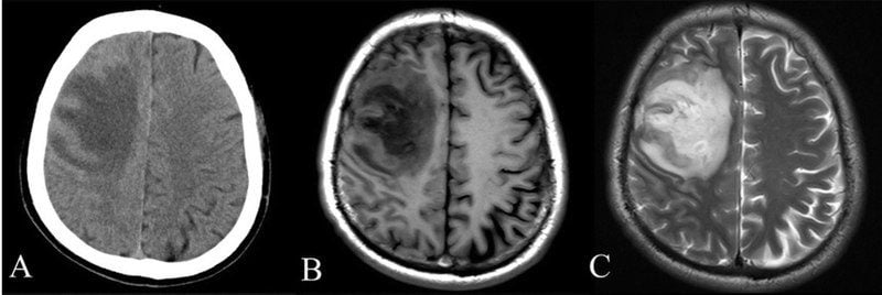 800px Ct And Mri Scan Of The Brain With Melioidosis