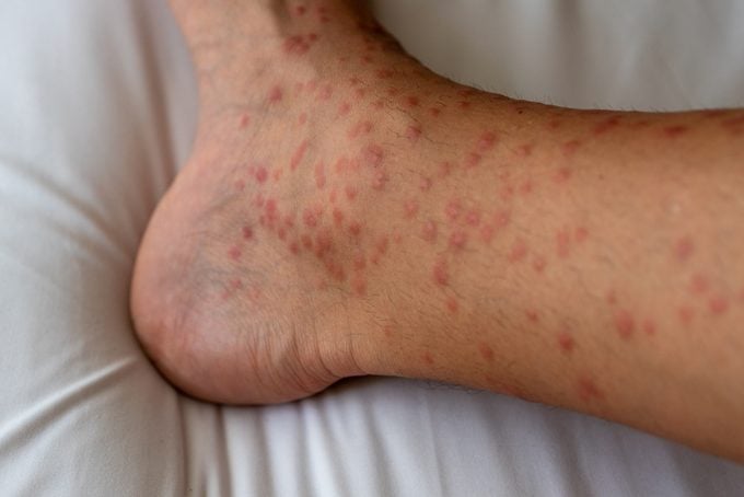 mosquitos bite on the leg close up