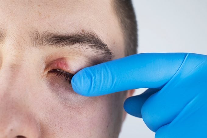 A doctor examines a patient who has blepharitis. Treatment of inflammation and redness of the eyelid. Infection of the skin around the eyes. The concept of providing quality medical care