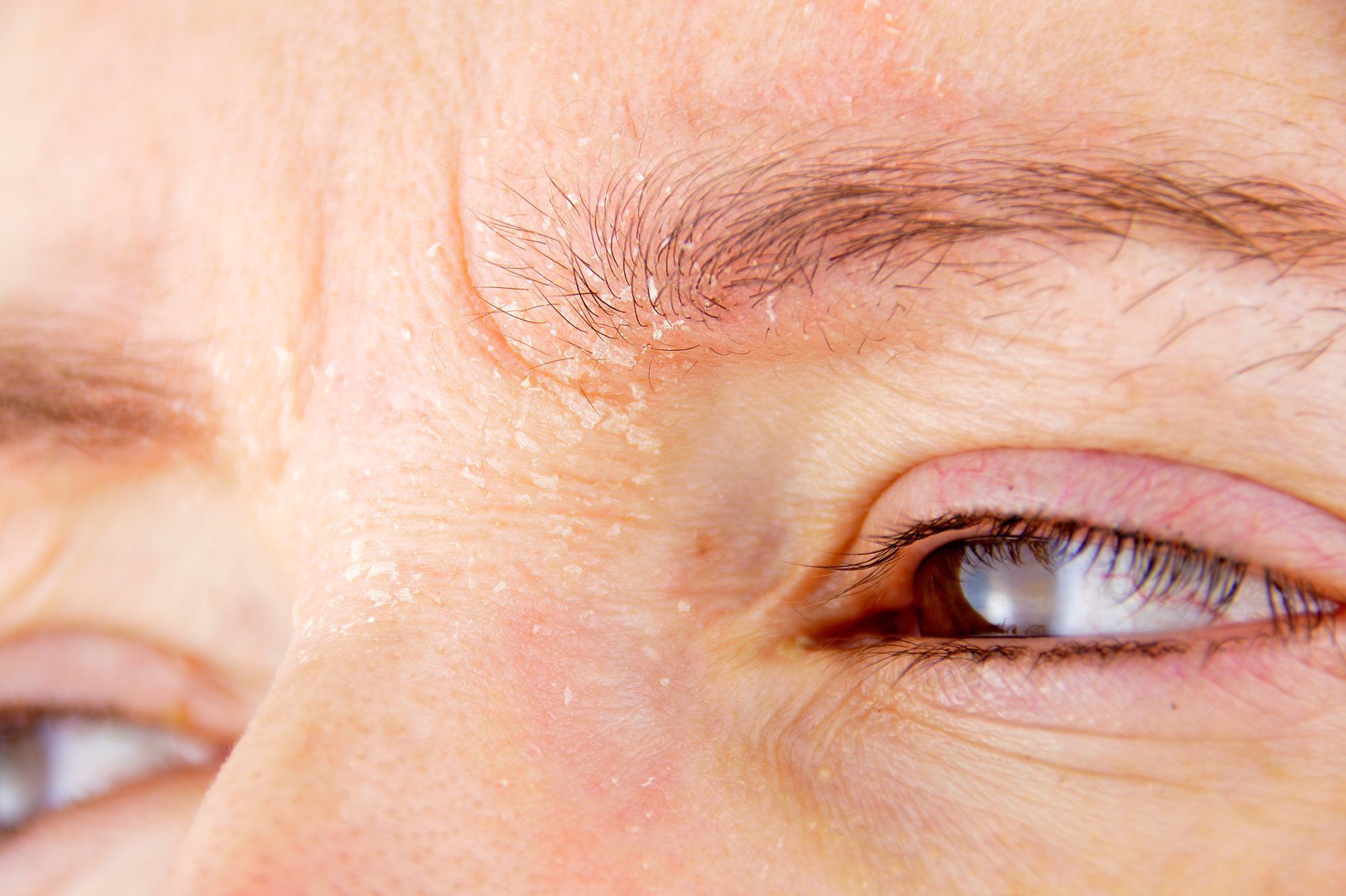 Eyebrow Dandruff: Why It Happens and How to Get Rid of It | The Healthy